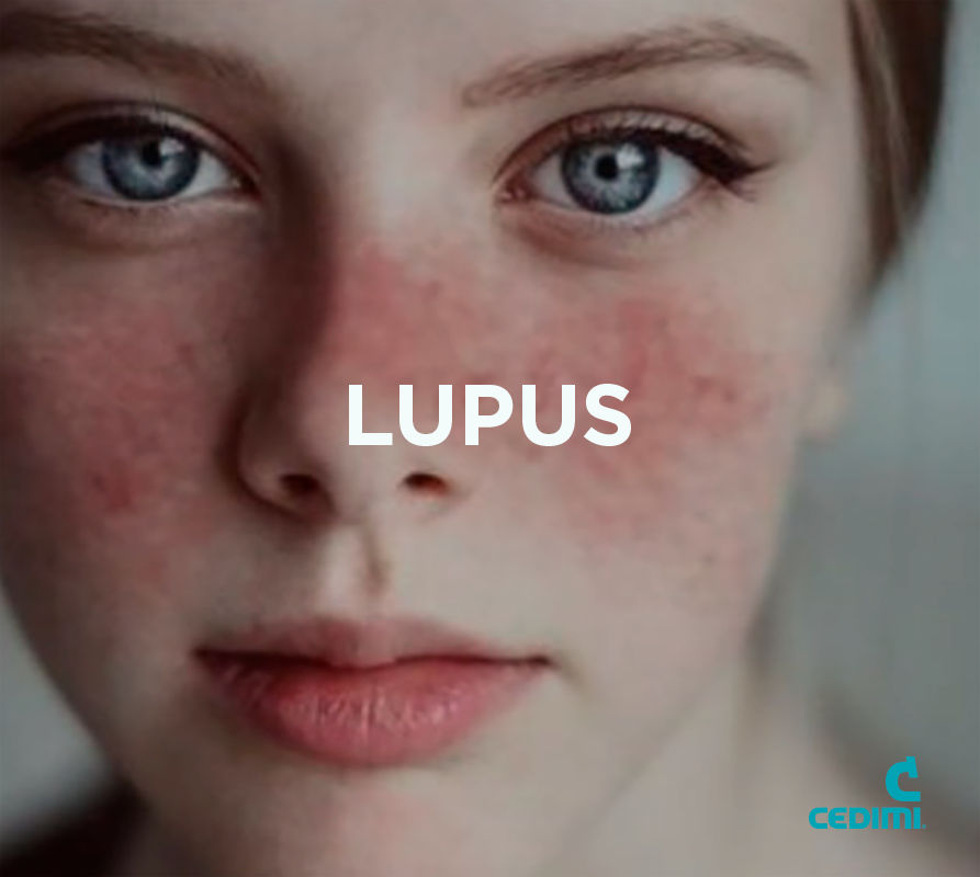 Cedimi, Lupus Eritematoso Sistémico (LES)